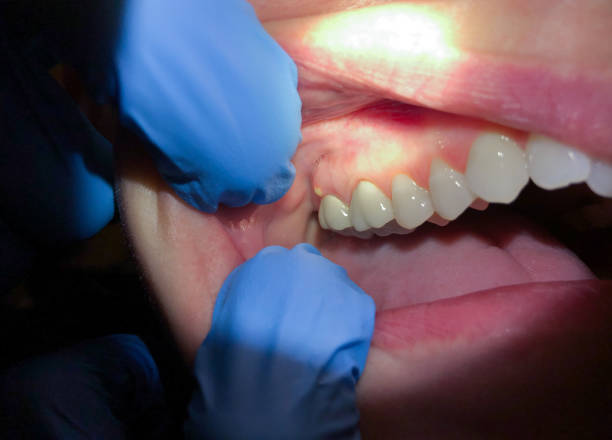 Emergency Dental Filling Replacement in MD